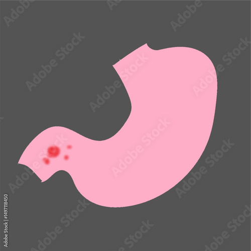 duodenal ulcer science illustration useful for healthcare projects and educational purposes.eps