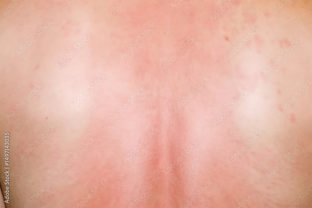 Closeup of Sunburned Skin on Human Back Showing Redness and Irritation Closeup of Sunburned Skin on Human Back Showing Redness and Irritation