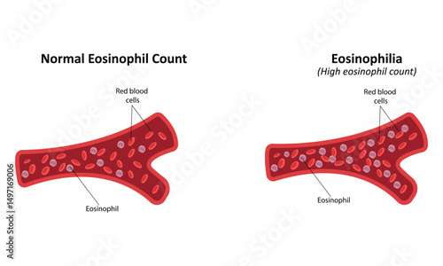 Eosinophilia vector illustration