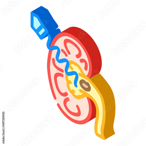 lithotripsy urology isometric icon vector illustration