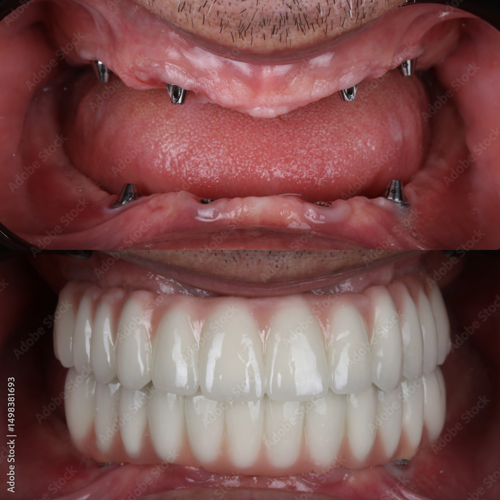 Fototapeta premium Treatment of tooth loss with jawbone implants. Full arch denture prosthesis on multiple dental implants. Dental before after and smile makeover.