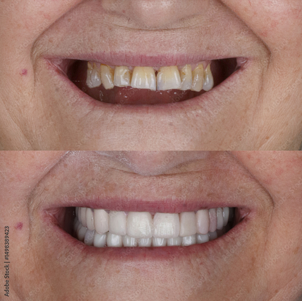 Obraz premium Dental treatment in dentistry. Smile design treatment with dental design. New tooth design with porcelain crowns. Full arch dental treatment. Dental before after and smile makeover.