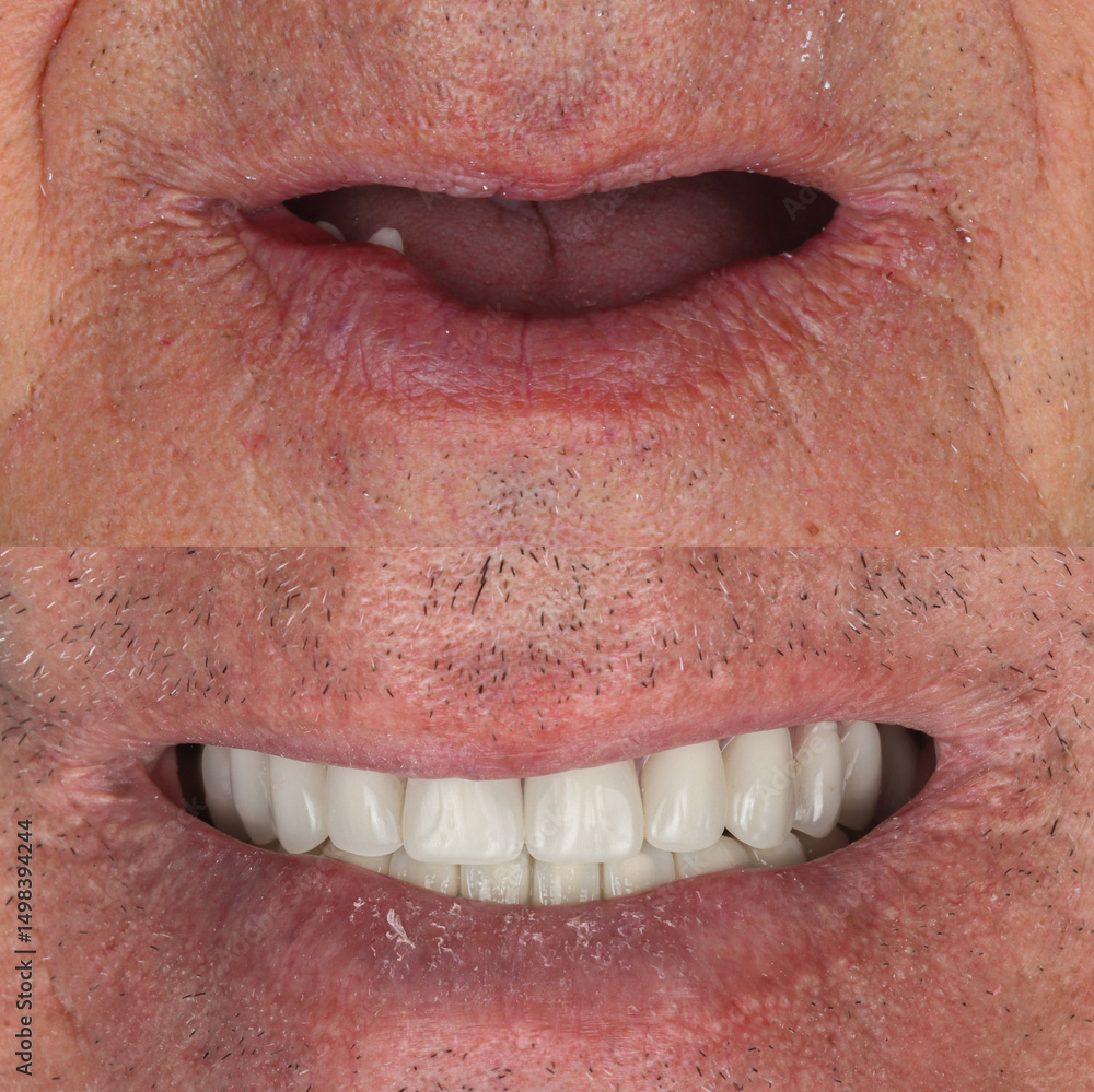 Obraz premium Full-arch denture prosthesis with dental implants placed in the jawbone. Full arch implant treatment with porcelain prosthesis. Dental before after and smile makeover.