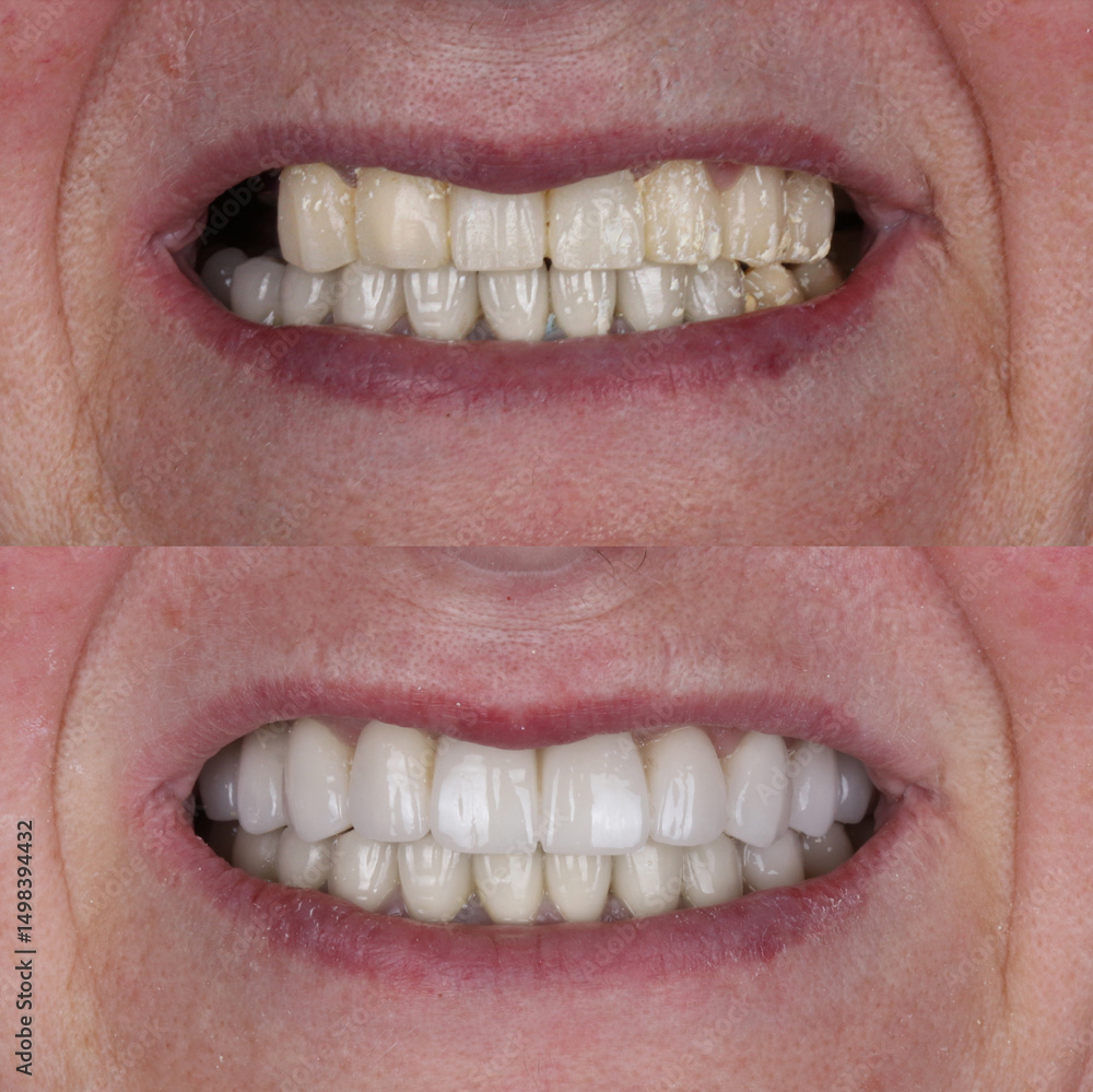 Fototapeta premium Dental implant treatment with oral surgery. Treatment of tooth loss. Porcelain dental prosthesis placed on implants embedded in the jawbone. Dental before after and smile makeover.