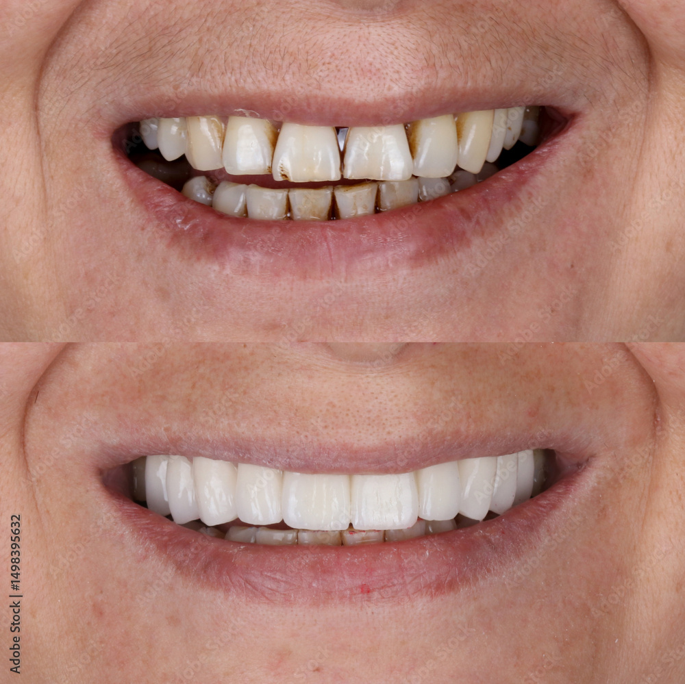 Obraz premium Dental design treatment in aesthetic dentistry. Full mouth smile makeover with glass ceramic porcelains. Dental veneers and bridge treatment. Dental before after and smile makeover.