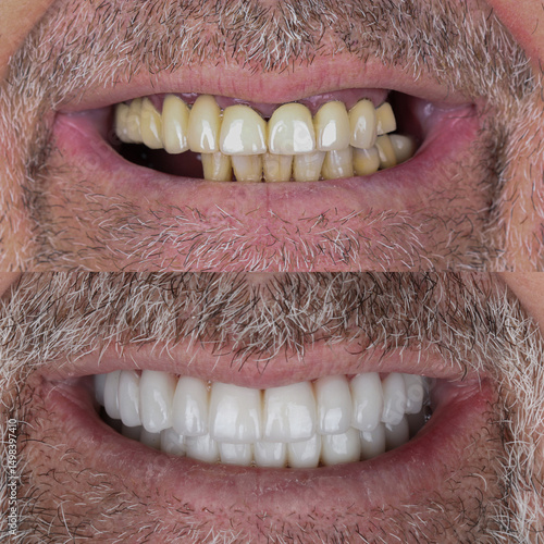 Canvas Print Full mouth porcelain crown treatment in cosmetic dentistry