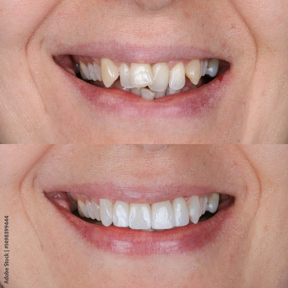 Obraz premium Dental treatment in dentistry. Smile design treatment with dental design. New tooth design with porcelain crowns. Full arch dental treatment. Dental before after and smile makeover.