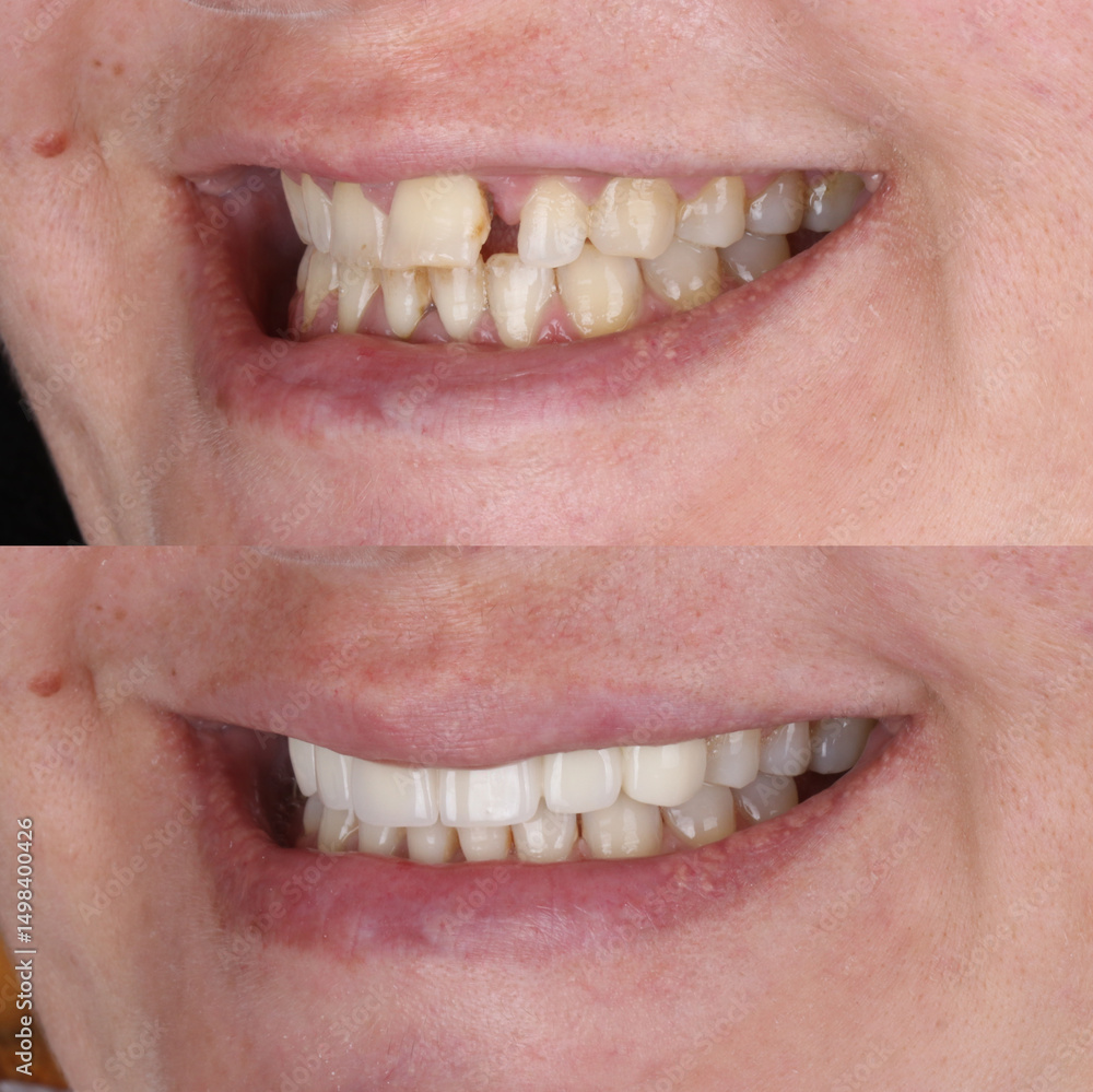 Fototapeta premium Dental treatment in dentistry. Smile design treatment with dental design. New tooth design with porcelain crowns. Full arch dental treatment. Dental before after and smile makeover.