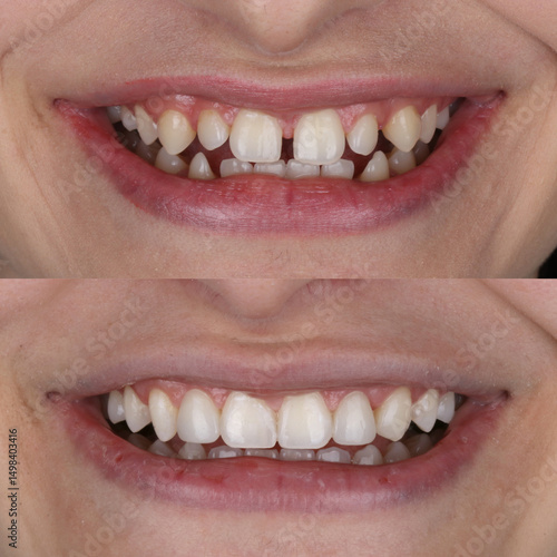 Valokuva Treatment of deformed and discolored teeth with composite filling in dental care