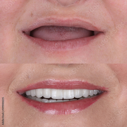 Bone level dental implants and full arch dental prosthesis in dentistry. Full mouth implant supported prosthesis for edentulous jaws. Dental before after and smile makeover.

