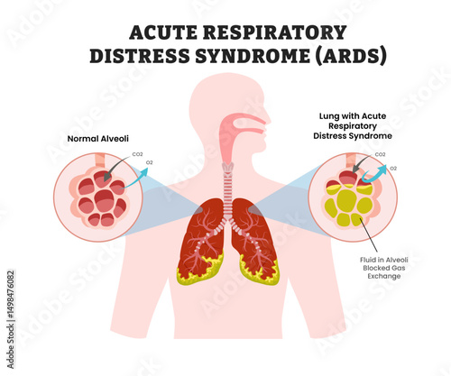 Acute Respiratory Distress Syndrome (ARDS) , educational medical poster design healthcare scheme, human lung disease internal organs. Labeled wet fluid in alveoli blocked gas exchange.