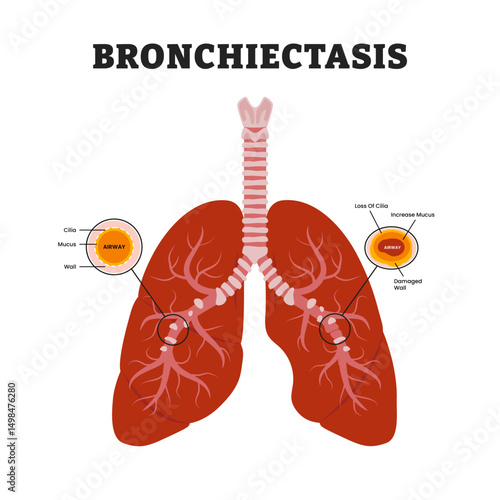 Bronchiectasis Lungs or Cystic Fibrosis, educational medical poster design healthcare scheme, human lung disease internal organs. Labeled damaged wall airway, increase mucus, loss of cilia.