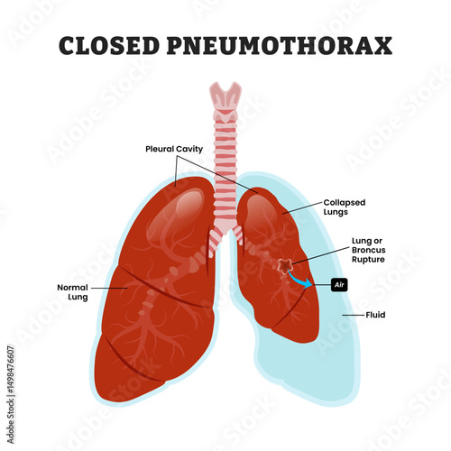 Closed Pneumothorax Lung, educational medical poster design healthcare scheme, human lung disease internal organs. Labeled collapsed lung, bronchial rupture, trapped air leaks.