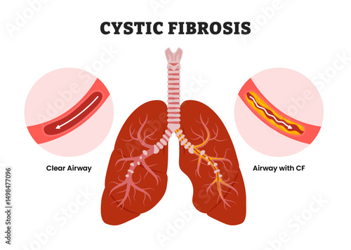 Cystic Fibrosis, educational medical poster design healthcare scheme, human lung disease internal organs. Labeled clear airway with airway cystic fibrosis. Bronchiectasis Lungs.