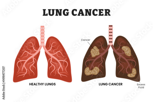 Healthy Lungs vs Lung Cancer or bronchogenic carcinoma,, educational medical poster design healthcare scheme, human lung disease internal organs. Labeled excess fluid, malignant tumor, parenchyma.