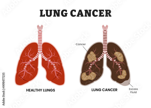 Healthy Lungs vs Lung Cancer or bronchogenic carcinoma,, educational medical poster design healthcare scheme, human lung disease internal organs. Labeled excess fluid, malignant tumor, parenchyma.