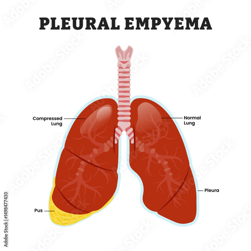 Pleural Empyema Lung, pyothorax or purulent pleuritis, educational medical poster design healthcare scheme, human lung disease internal organs. Labeled compress lung with pus pleural space.