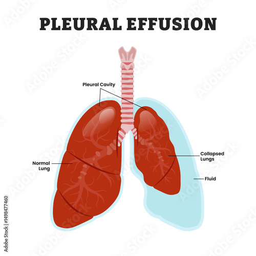 Pleural Effusion or Pneumothorax Lung, educational medical poster design healthcare scheme, human lung disease internal organs. Labeled collapsed lung, bronchial rupture, trapped air leaks.