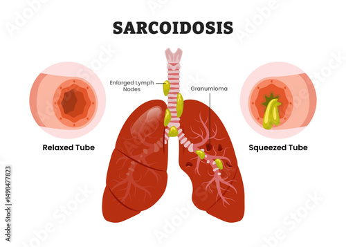 Sarcoidosis Lungs, educational medical poster design healthcare scheme, human lung disease internal organs. Labeled enlarged lymph nodes, granuloma, relaxed and squeeze tube, inflammatory cells.