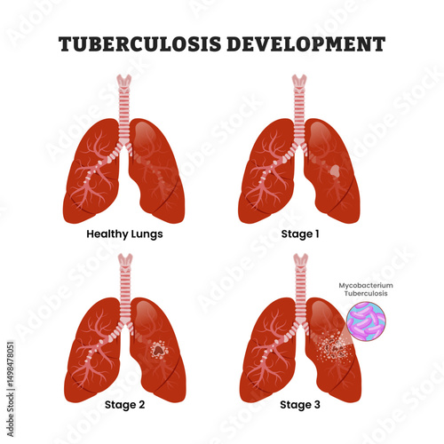 TB Tuberculosis Development Stages Diagram Process, educational medical poster design healthcare scheme, human lung disease internal organs. Labeled Mycobacterium Tuberculosis Bacteria.