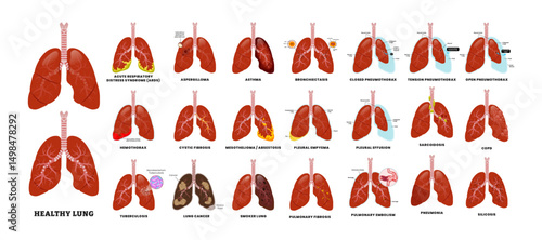 Big Set of Lung Disease set collection, educational medical poster design healthcare scheme, human lung disease internal organs. Labeled Pulmonary Fibrosis, Aspergilloma,Hemothorax, COPD, Pneumothorax
