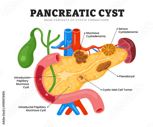 Pancreatic Cyst or cystic formation, educational medical poster design healthcare scheme, human pancreas disease internal organs.Labeled Serous, Mucinous Cystadenoma, Pseudocyst, Intraductal Papillary