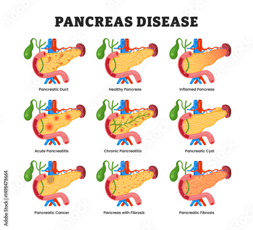 Set of Pancreas Disease Set Collection, educational medical poster design healthcare scheme, human pancreas disease internal organs. Labeled Acute, Chronic, Healthy, Inflamed, Fibrosis, Cancer, Cyst.