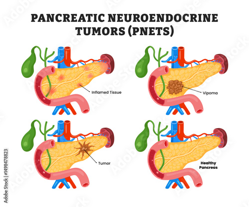 Pancreatic Neuroendocrine Tumors PNETS, educational medical poster design healthcare scheme, human pancreas disease internal organs. Labeled inflamed tissue, vipoma, tumors, pancreas cancer types.