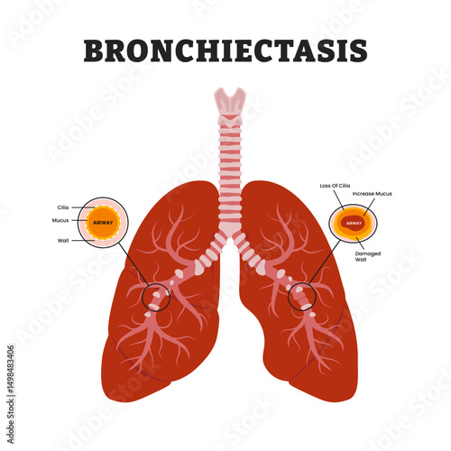 Bronchiectasis Lungs or Cystic Fibrosis, educational medical poster design healthcare scheme, human lung disease internal organs. Labeled damaged wall airway, increase mucus, loss of cilia.