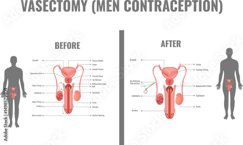 Vasectomy Male Birth Control Procedure and Benefits Explained