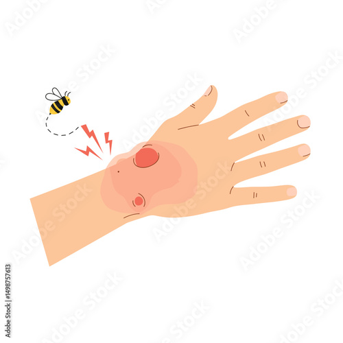 Hand with bee sting showing redness and pain signals  