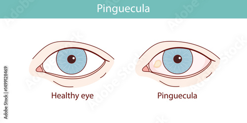 Pinguecula eyes vector anatomical illustration