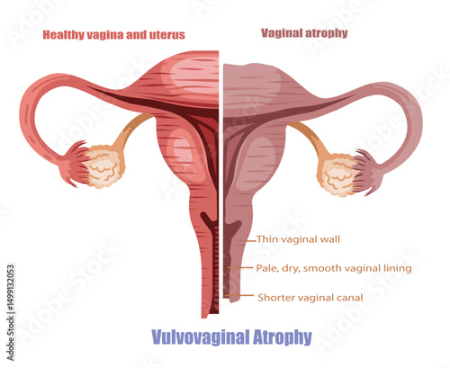 Vulvovaginal Atrophy