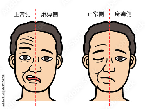 顔面神経麻痺の男性の顔、正常側と麻痺側の対比
