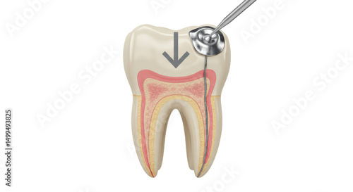 Isolated Tooth Cross Section with Dental Instrument Performing Root Canal Treatment