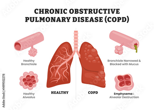 Chronic Obstructive Pulmonary Disease (COPD) vs Healthy Lungs, educational medical poster design healthcare scheme, human lung disease internal organs. Labeled bronchiole and alveolus.
