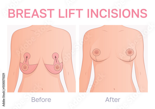 Vector illustration showing breast lift surgery technique. 