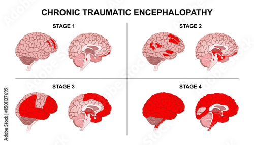 Chronic Traumatic Encephalopathy Brain Illustration