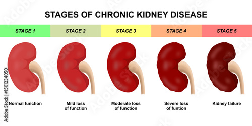 Chronic Kidney Disease Stages (CKD) Illustration