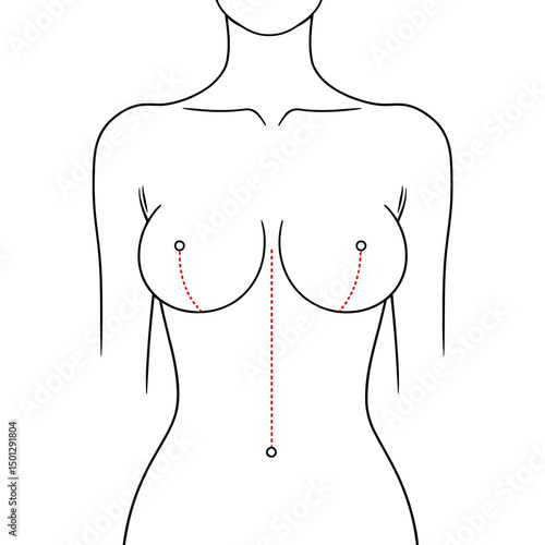 Female breast augmentation surgery diagram