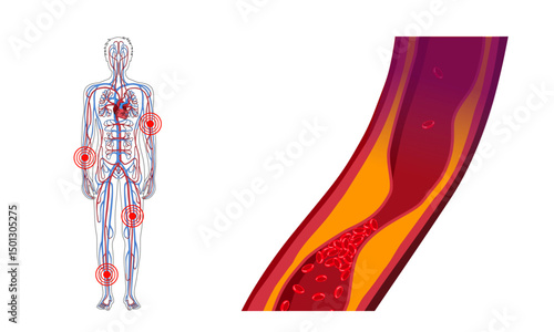 Peripheral artery disease. Ischemia in the legs and arms. Cholesterol, fat in human blood vessels. blockage in blood vessels. Vector illustration for medical poster, clinic or science study