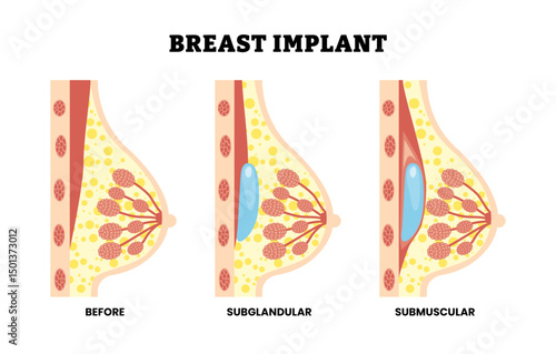 Different types of breast implant types with side view, educational medical poster design healthcare scheme, labeled healthy breast, subglandular, submuscular. Modify the size and shape of breasts.