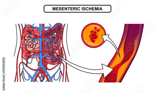 Mesenteric ischemia, intestinal ischemia, cholesterol, fat in human blood vessels. Colitis in the intestine. blocked blood vessels in the intestine. vector illustration for medical Poster