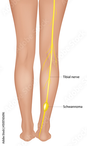 Tibial Nerve Schwannoma Illustration in Human Leg Anatomy. Medical Diagram of Schwannoma on Tibial Nerve – Peripheral Nerve Tumor Visualization