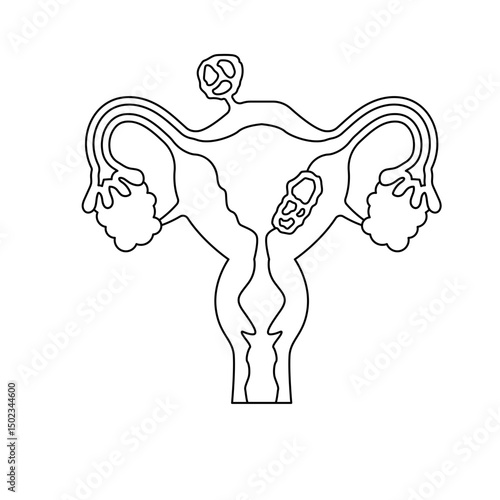 uterine fibroids