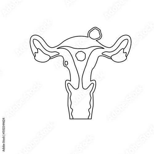 uterine fibroids