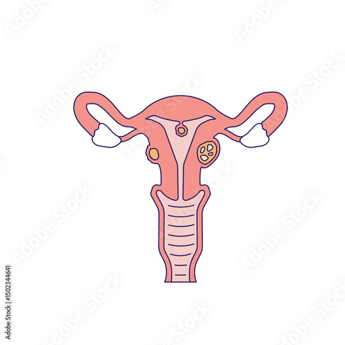 uterine fibroids