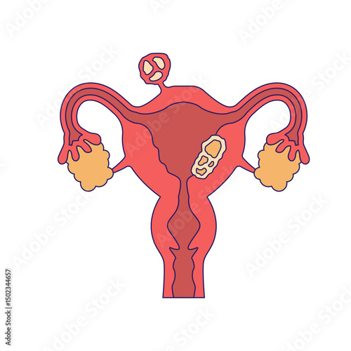 uterine fibroids
