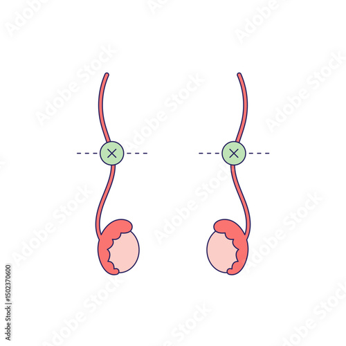 Vasectomy illustratrion