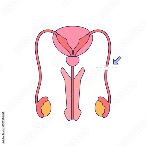 Vasectomy illustratrion